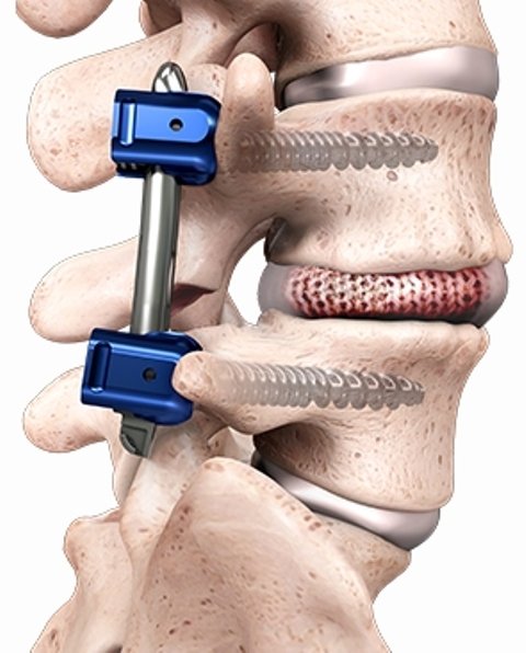 Spineology U.S. Clinical Trial for Interbody Fusion